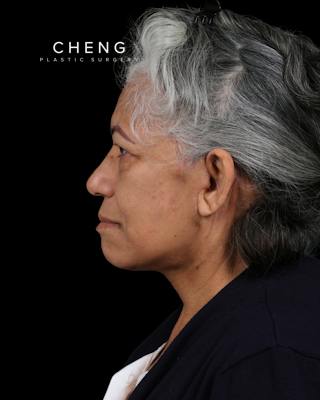 Facelift Before & After Gallery - Patient 364819 - Image 12