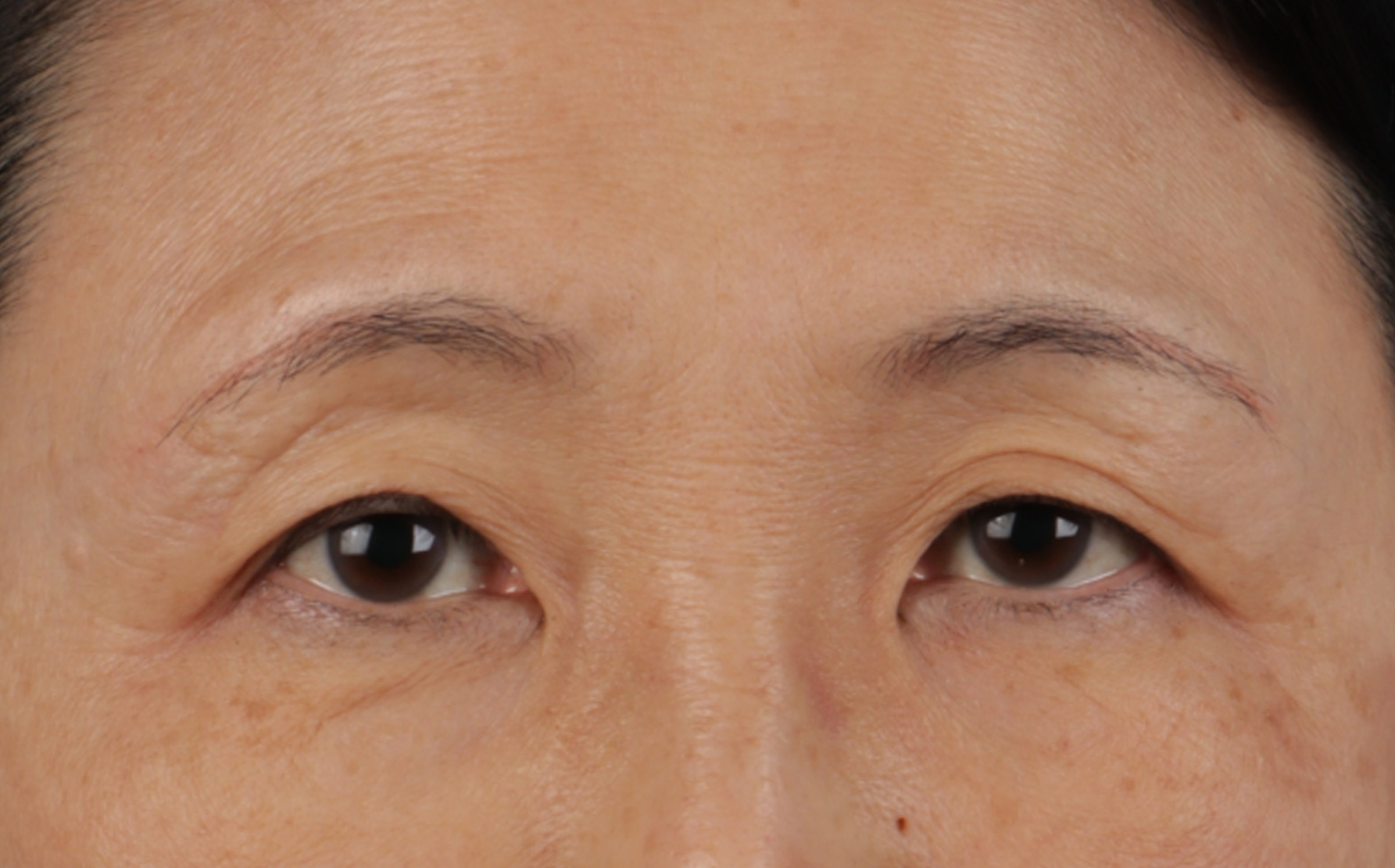Blepharoplasty Before & After Gallery - Patient 680546 - Image 1