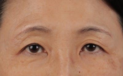 Blepharoplasty Before & After Gallery - Patient 680546 - Image 1