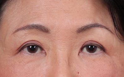 Blepharoplasty Before & After Gallery - Patient 680546 - Image 2