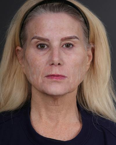 Facelift Before & After Gallery - Patient 105916 - Image 1