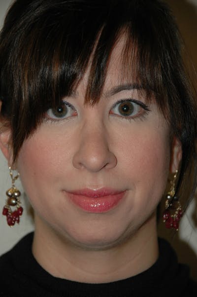 Chin & Cheek Augmentation