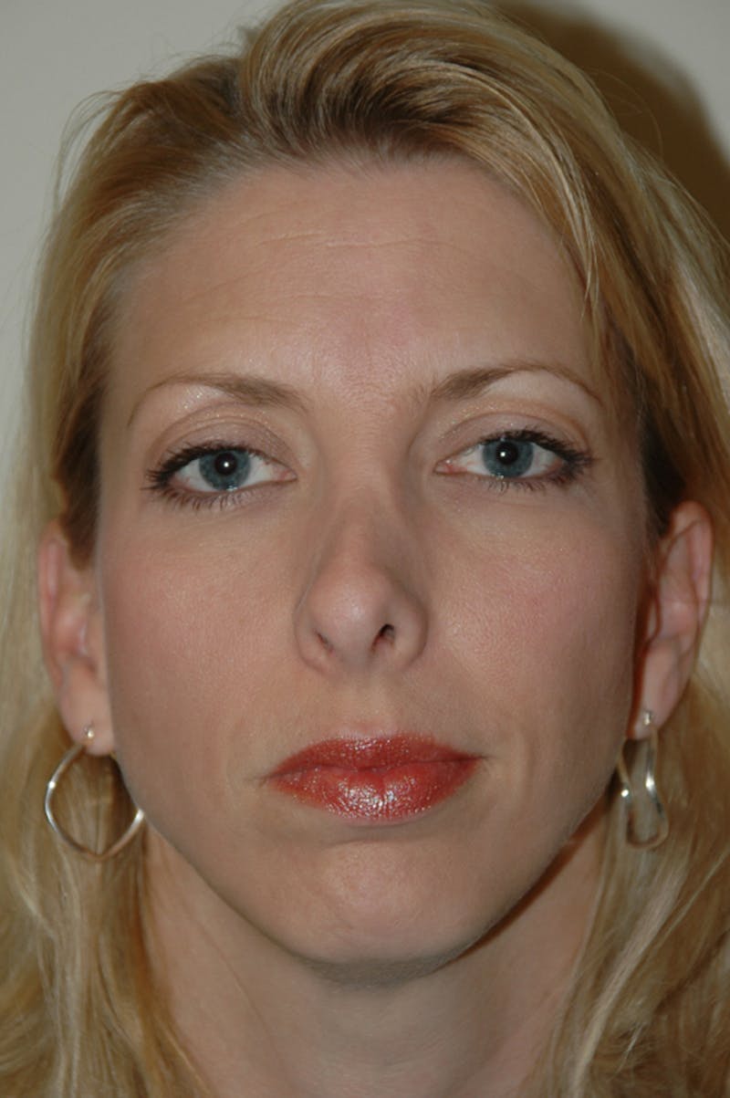 Revision Rhinoplasty Before & After Gallery - Patient 54673300 - Image 3