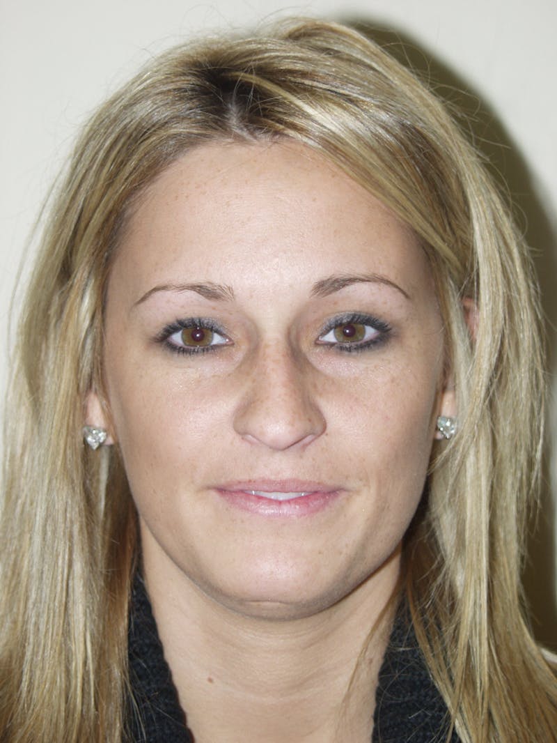 Rhinoplasty Before & After Gallery - Patient 53824148 - Image 3