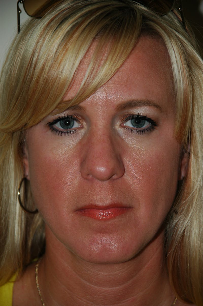 Rhinoplasty Before & After Gallery - Patient 53824531 - Image 3