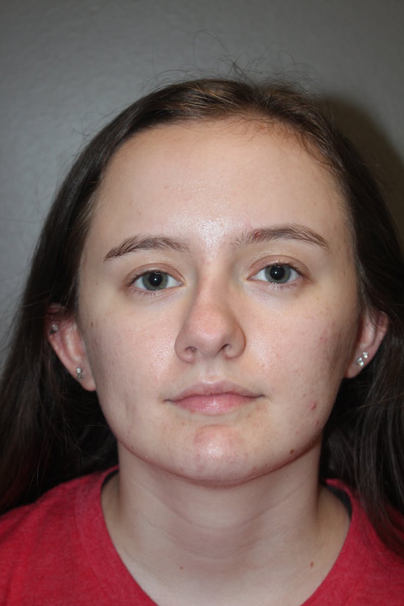 Rhinoplasty Before & After Gallery - Patient 141113621 - Image 9