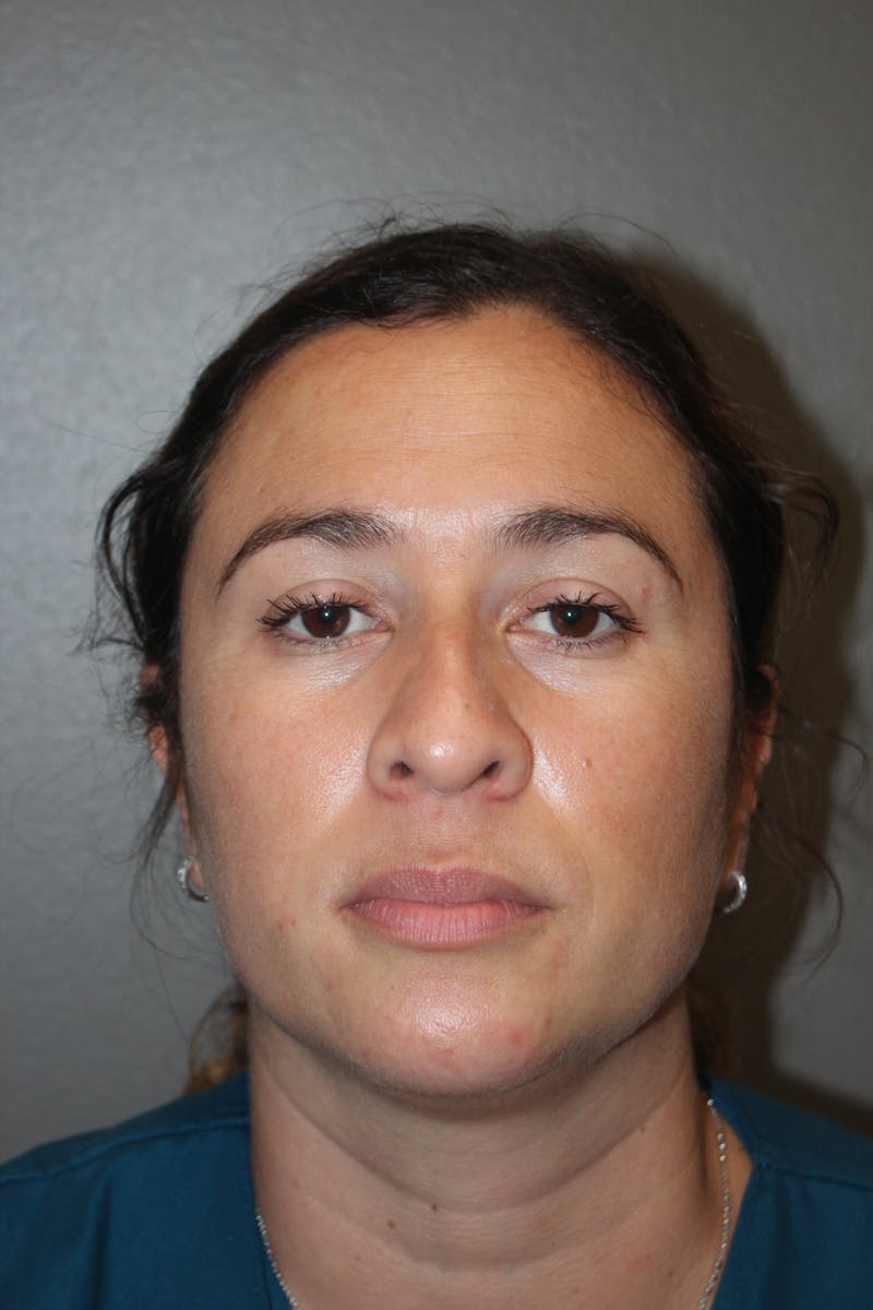 Rhinoplasty Before & After Gallery - Patient 141113615 - Image 9