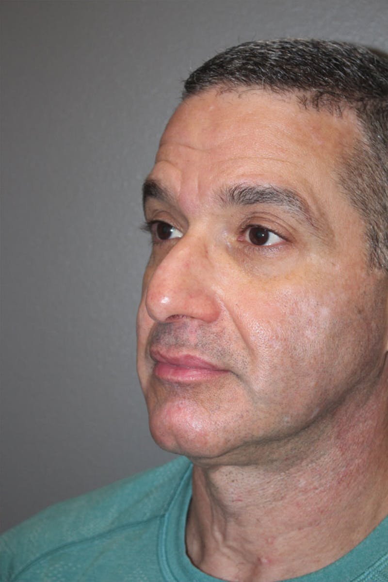 Rhinoplasty Before & After Gallery - Patient 146669176 - Image 5