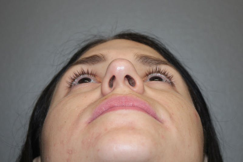 Rhinoplasty Before & After Gallery - Patient 146669491 - Image 9