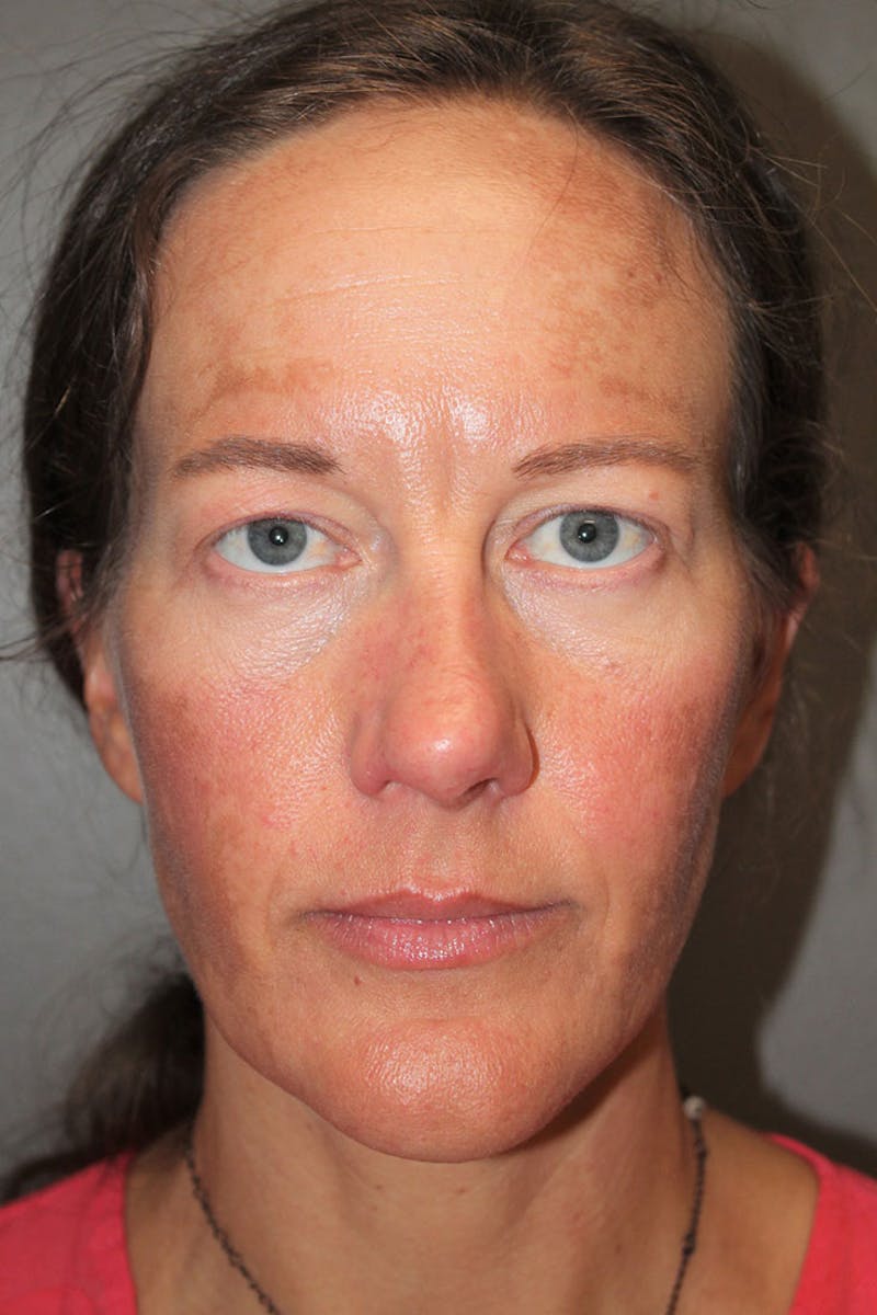 Rhinoplasty Before & After Gallery - Patient 146669489 - Image 3