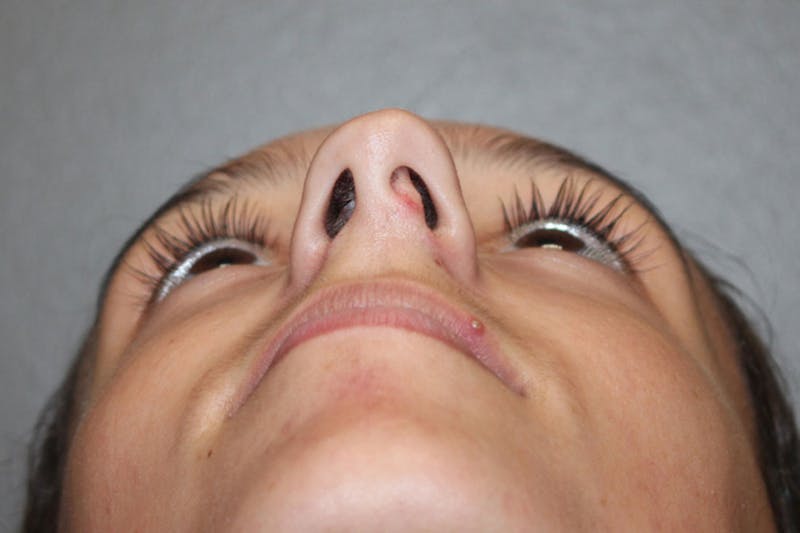 Rhinoplasty Before & After Gallery - Patient 146669560 - Image 11