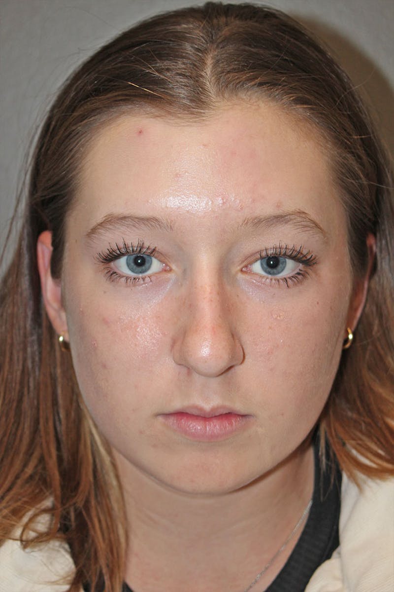 Rhinoplasty Before & After Gallery - Patient 146669558 - Image 3