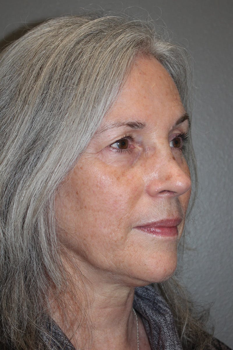 Rhinoplasty Before & After Gallery - Patient 174971771 - Image 4