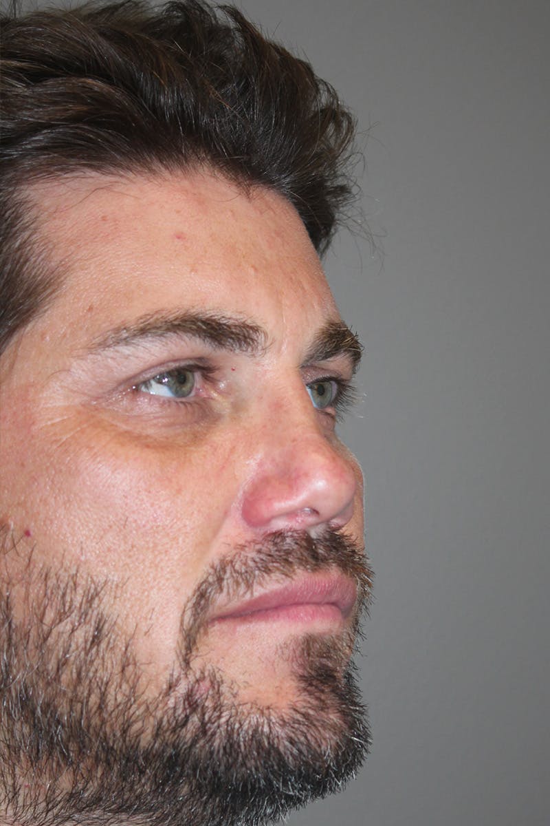 Rhinoplasty Before & After Gallery - Patient 174972180 - Image 3