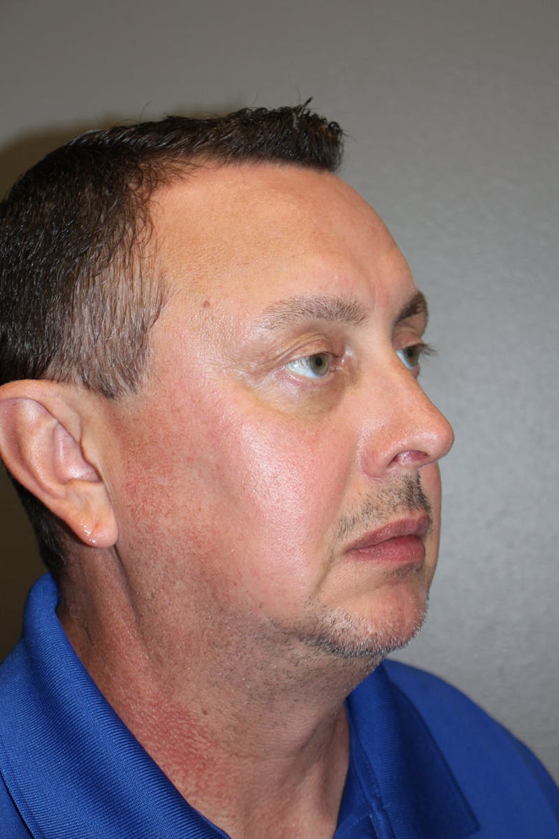 Rhinoplasty Before & After Gallery - Patient 218367 - Image 4