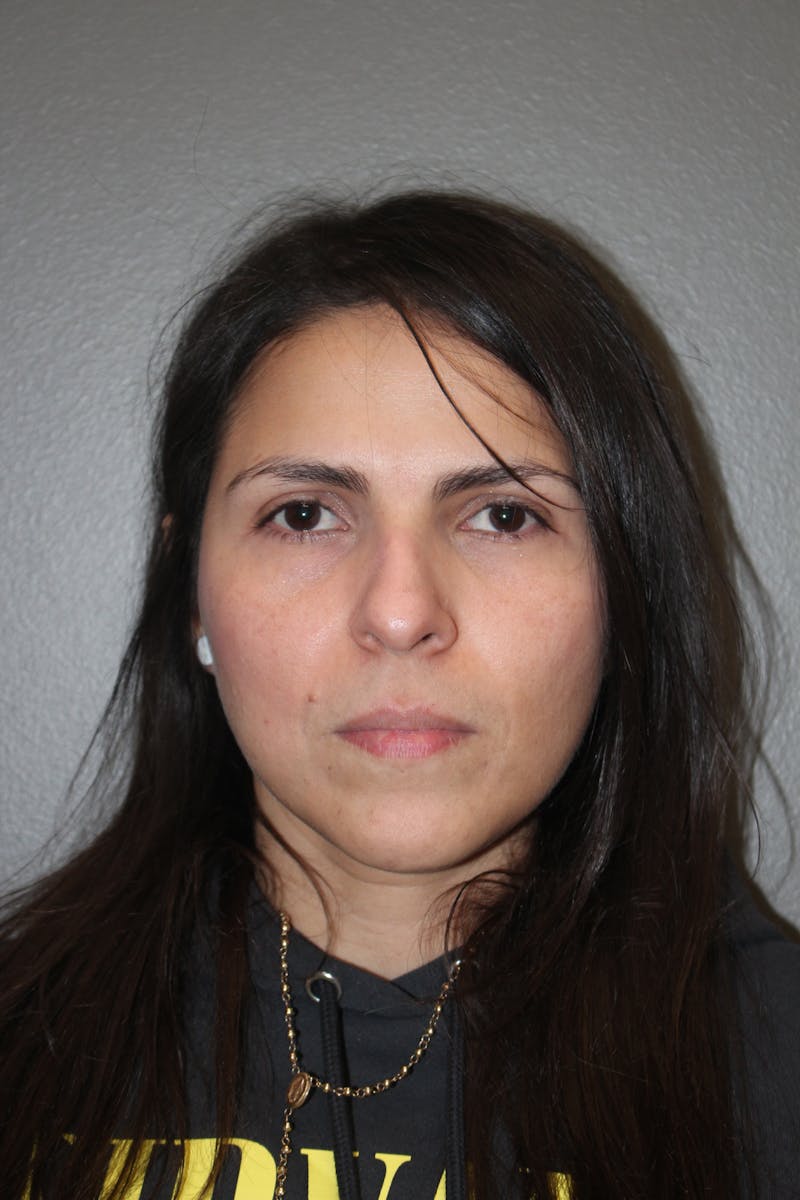 Rhinoplasty Before & After Gallery - Patient 415296 - Image 5