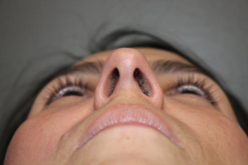 Rhinoplasty Before & After Gallery - Patient 415296 - Image 11