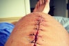 TJ Schiller's TBT to knee surgery is damn comical, slightly graphic