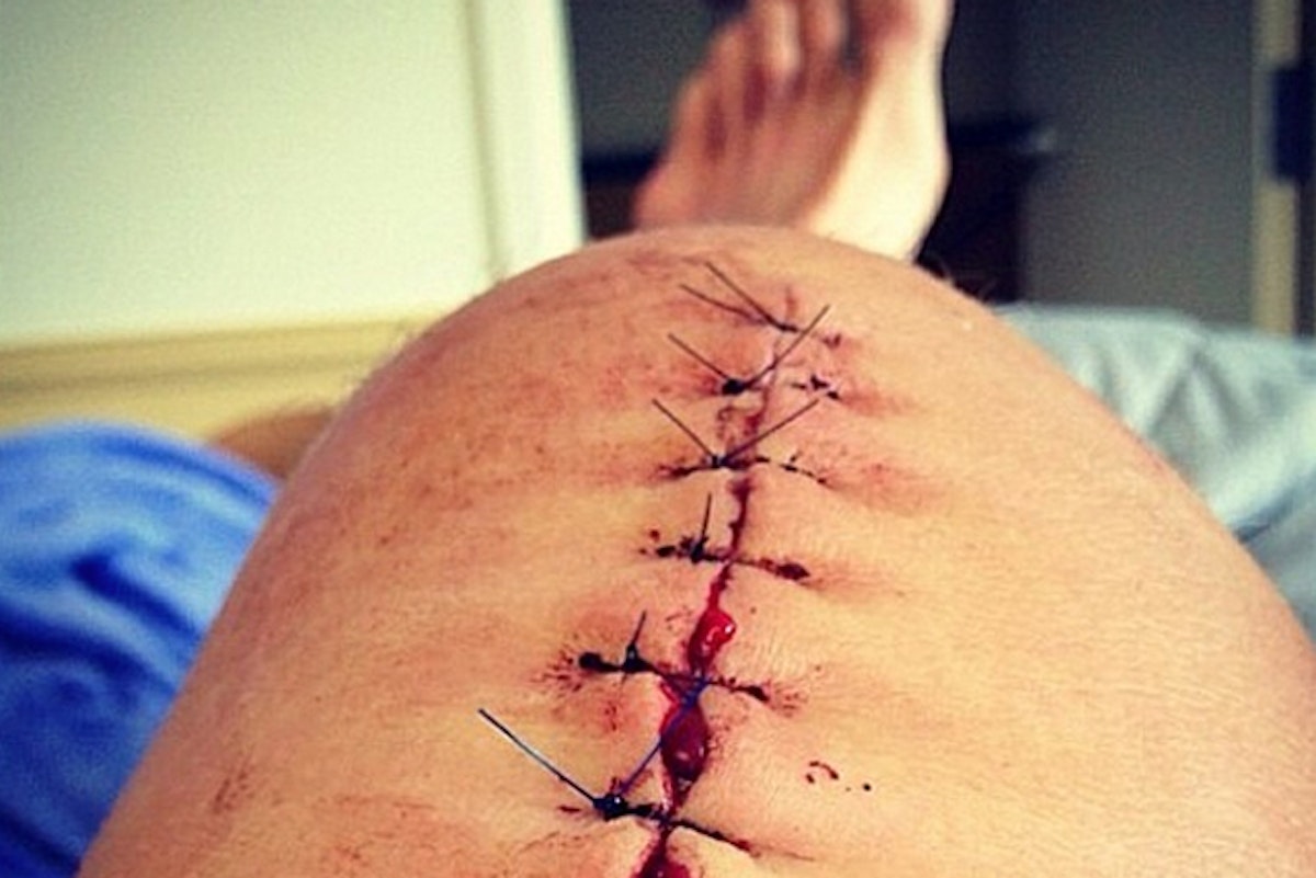 TJ Schiller's TBT to knee surgery is damn comical, slightly graphic