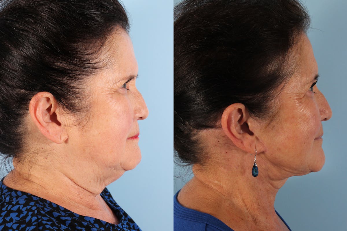 GLP-1 Weight Loss Before & After Gallery - Patient 367270 - Image 3