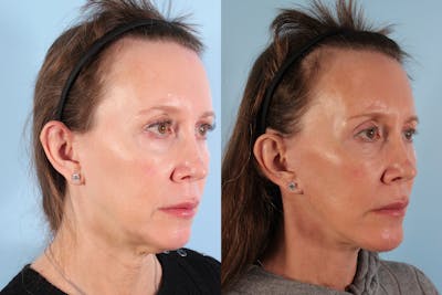 Facial Resurfacing Before & After Gallery - Patient 321569 - Image 1