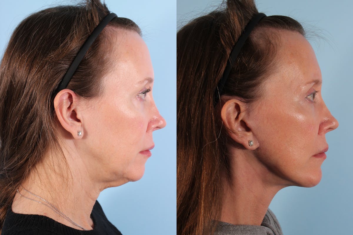 Facial Resurfacing Before & After Gallery - Patient 321569 - Image 2
