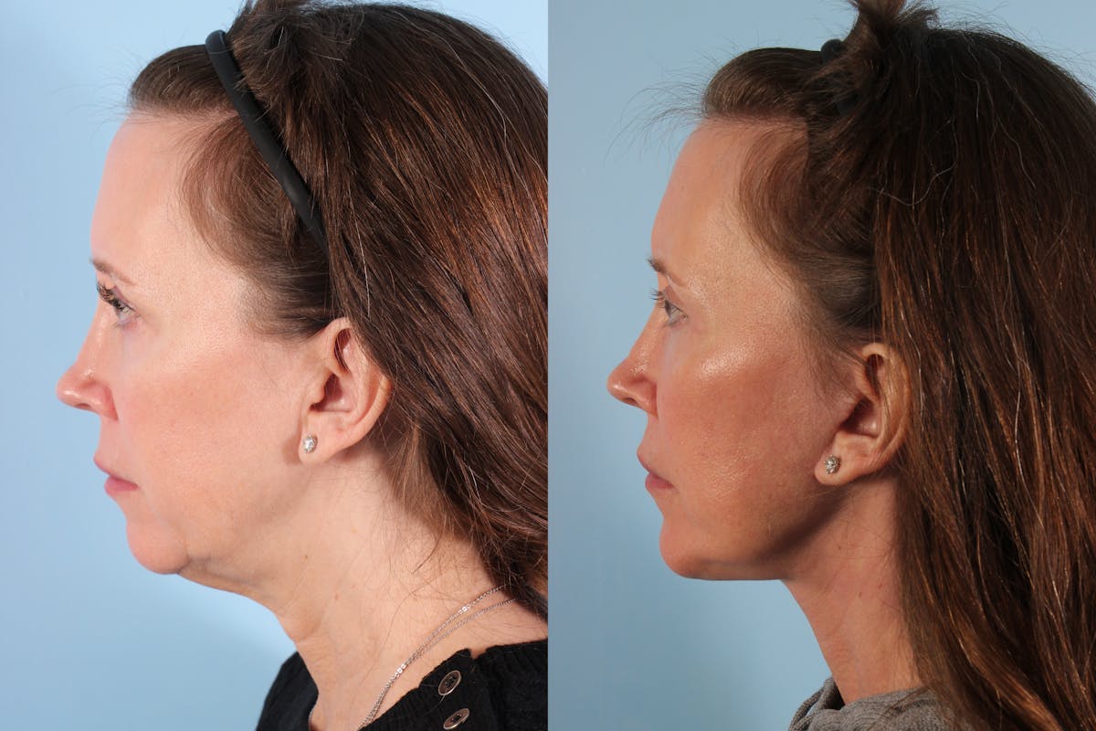 Facial Resurfacing Before & After Gallery - Patient 321569 - Image 3