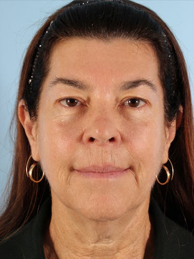 Facial Resurfacing Before & After Gallery - Patient 396503 - Image 1