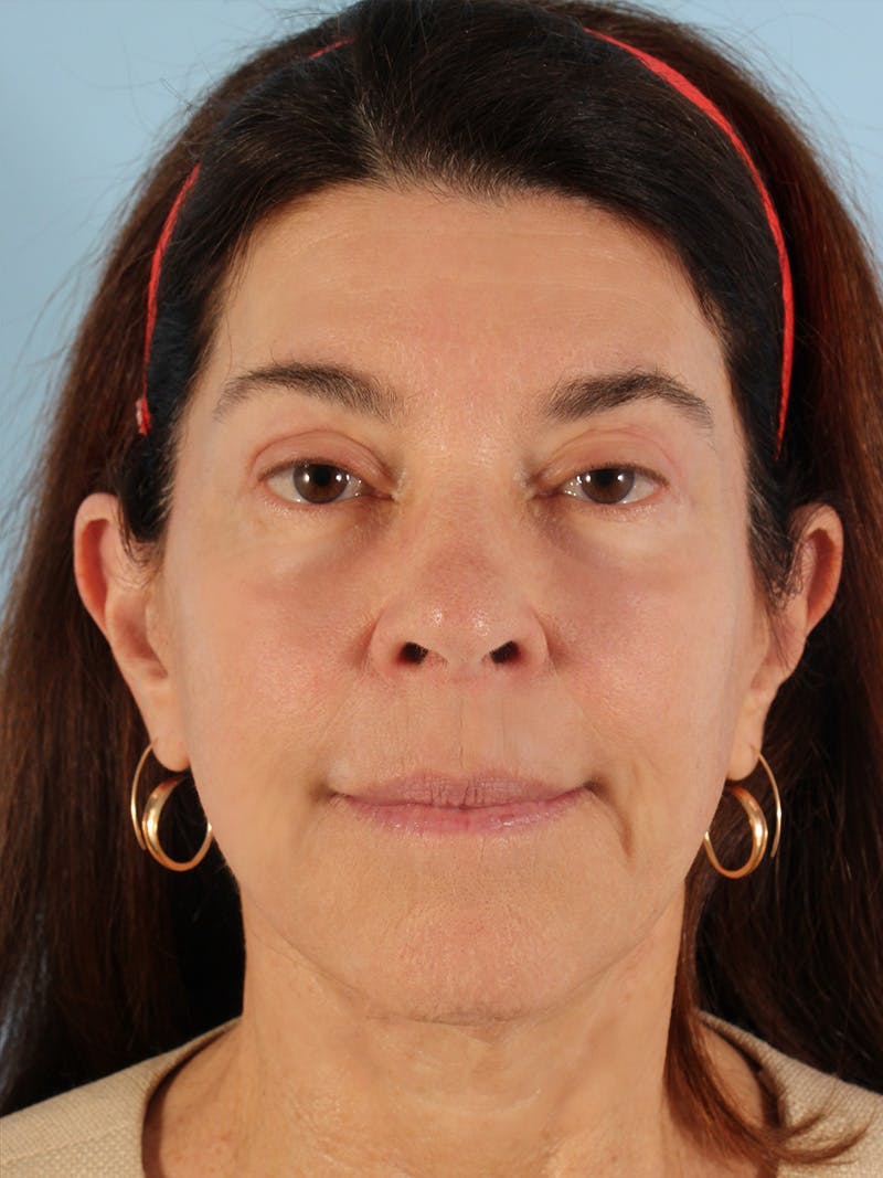 Facial Resurfacing Before & After Gallery - Patient 396503 - Image 2