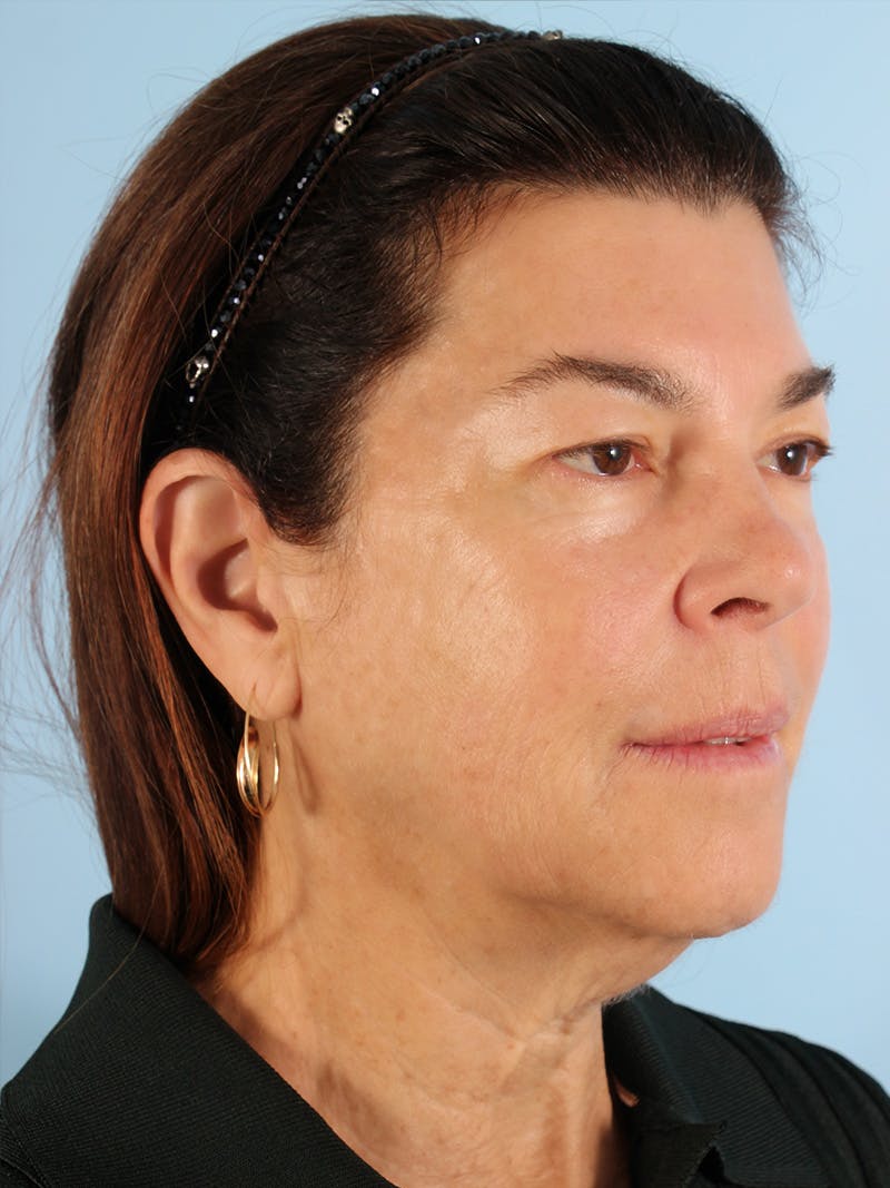 Facial Resurfacing Before & After Gallery - Patient 396503 - Image 3