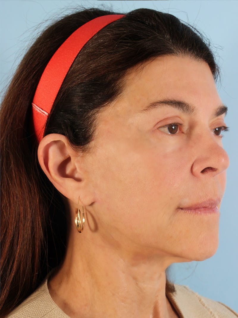 Facial Resurfacing Before & After Gallery - Patient 396503 - Image 4