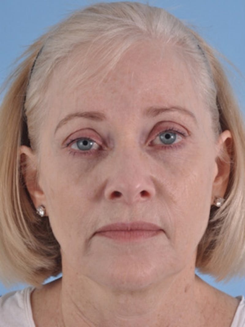 Facelift Surgery Before & After Gallery - Patient 891166 - Image 1
