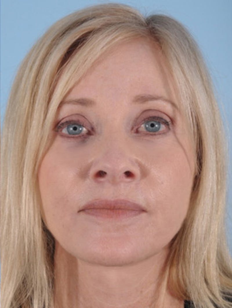 Facelift Surgery Before & After Gallery - Patient 891166 - Image 2