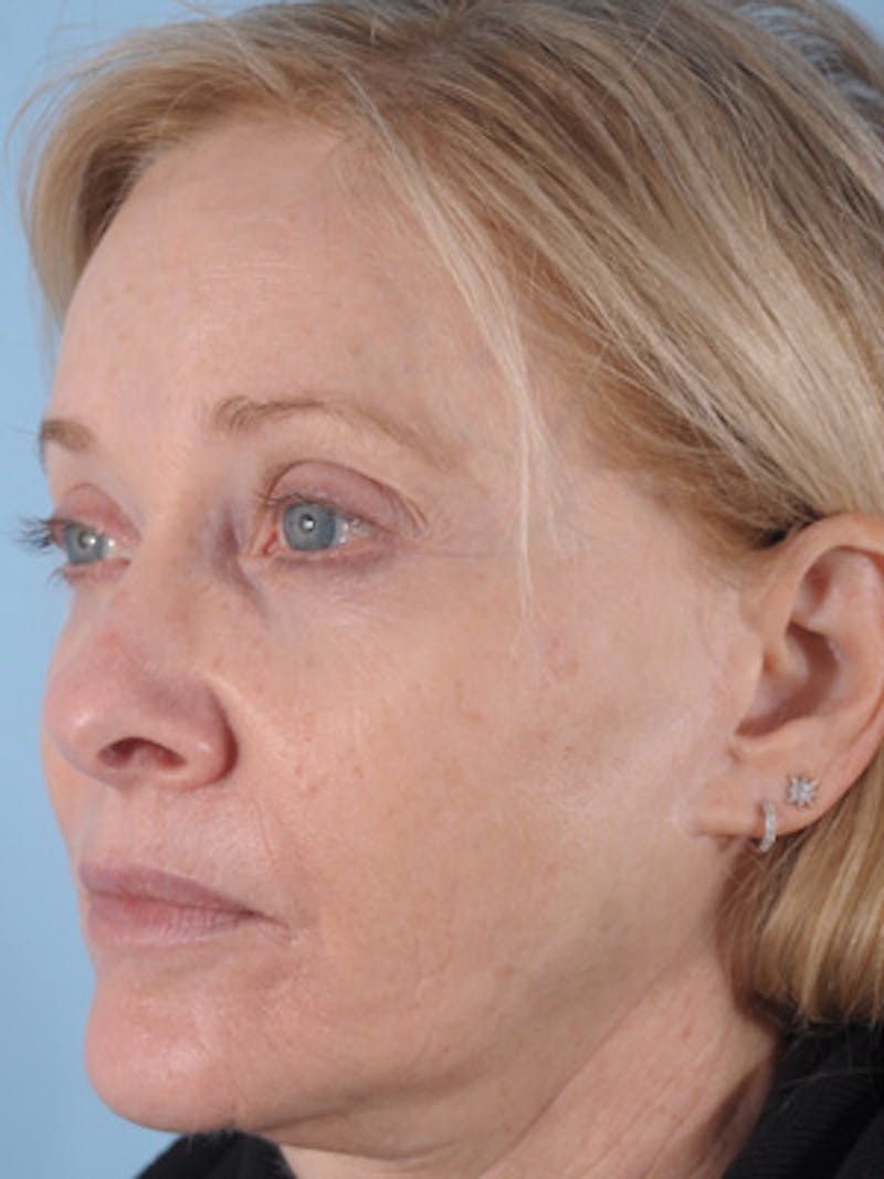Facelift Surgery Before & After Gallery - Patient 891166 - Image 3