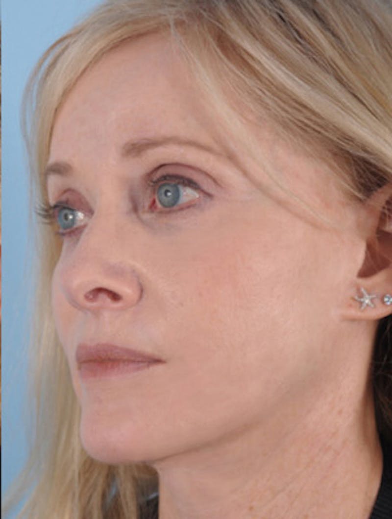 Facelift Surgery Before & After Gallery - Patient 891166 - Image 4