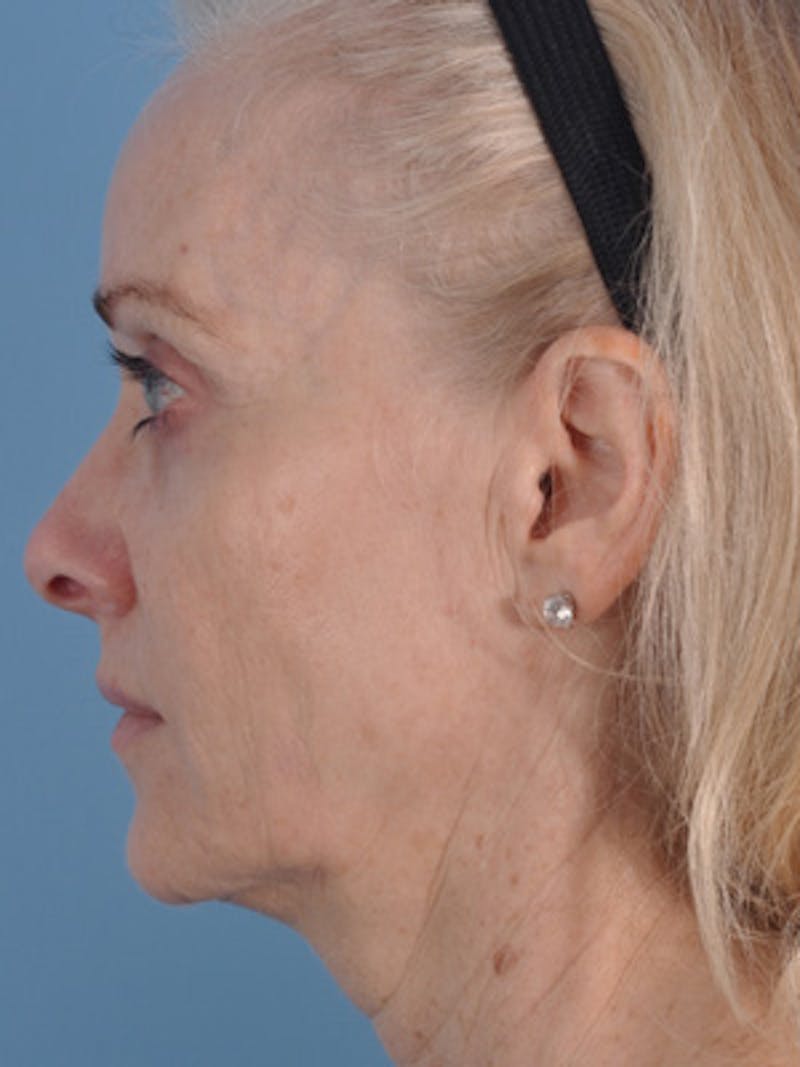 Facelift Surgery Before & After Gallery - Patient 891166 - Image 5