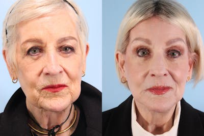 Facial Resurfacing Before & After Gallery - Patient 248047 - Image 1