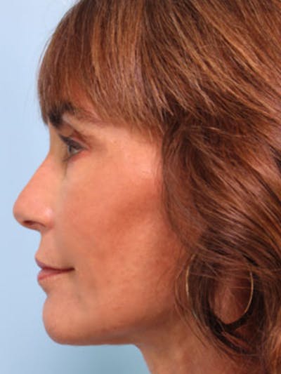 Neck Lift Before & After Gallery - Patient 254444 - Image 2