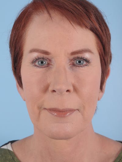 Facial Resurfacing Before & After Gallery - Patient 397937 - Image 2