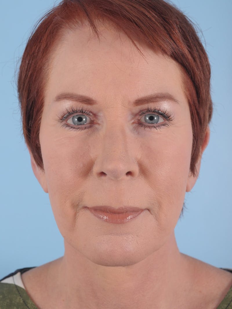 Facial Resurfacing Before & After Gallery - Patient 397937 - Image 2
