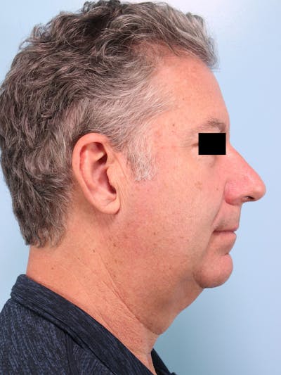 Liposuction Submental Before & After Gallery - Patient 165381 - Image 1