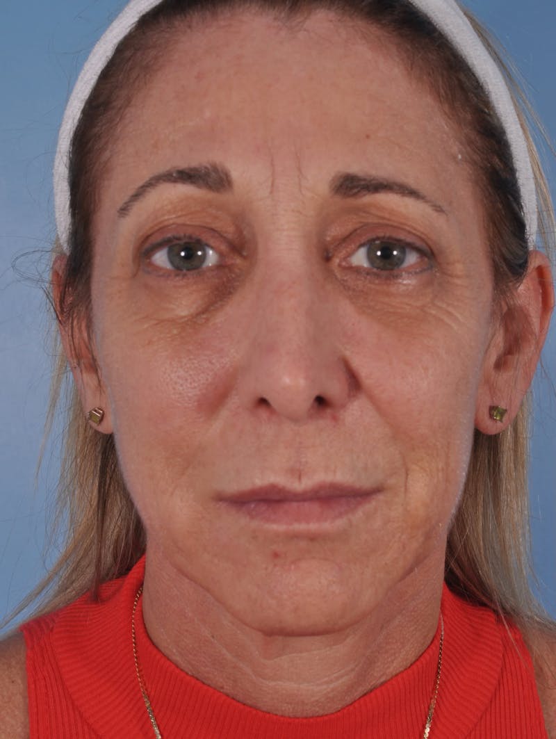 Upper Blepharoplasty Before & After Gallery - Patient 374057 - Image 1