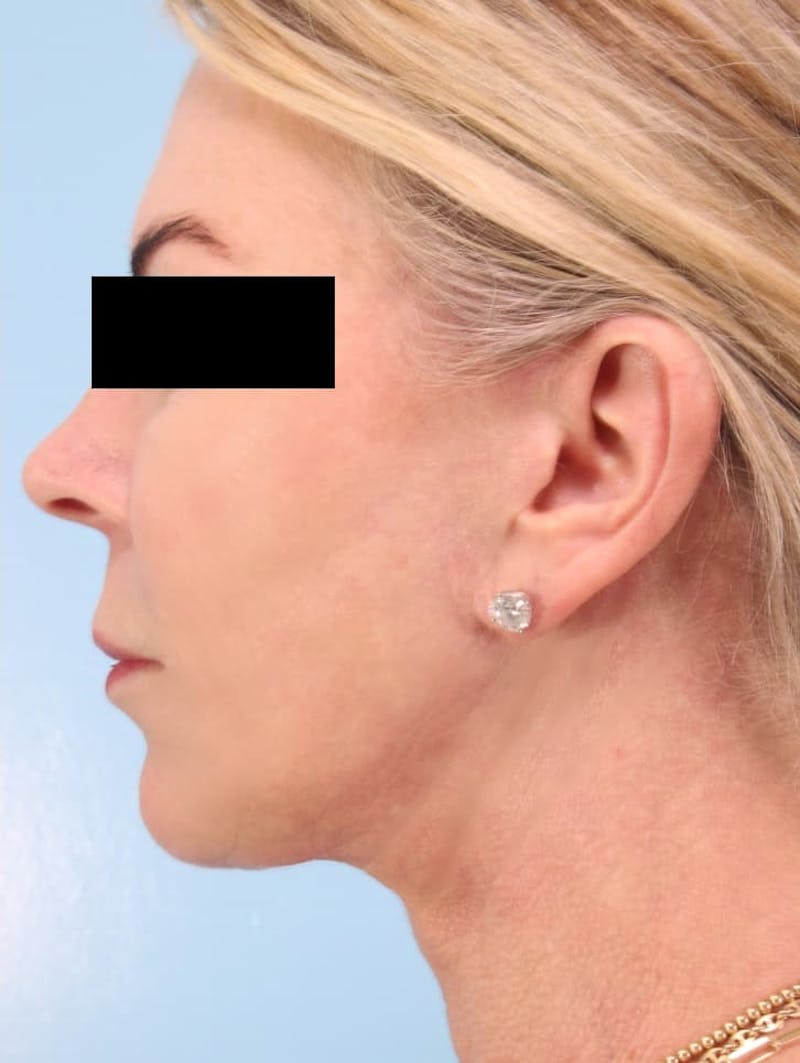 Facial Resurfacing Before & After Gallery - Patient 393654 - Image 4