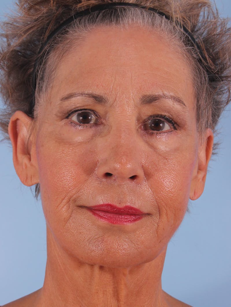Facelift Surgery Before & After Gallery - Patient 264597 - Image 1