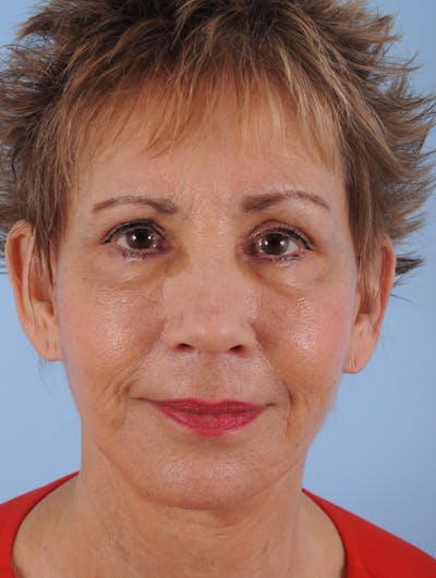 Facelift Surgery Before & After Gallery - Patient 264597 - Image 2