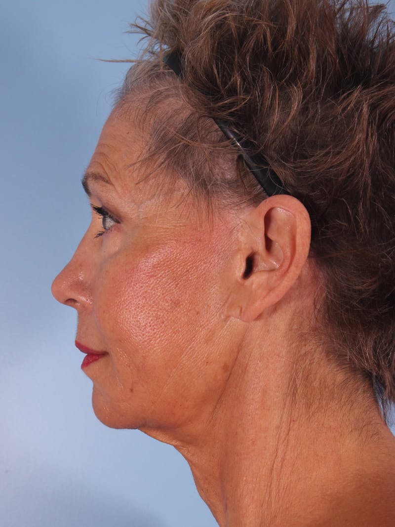 Facelift Surgery Before & After Gallery - Patient 264597 - Image 9