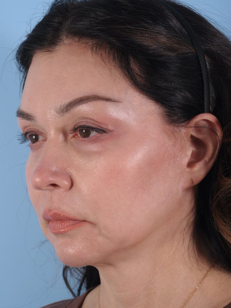 Facelift Surgery Before & After Gallery - Patient 980569 - Image 1