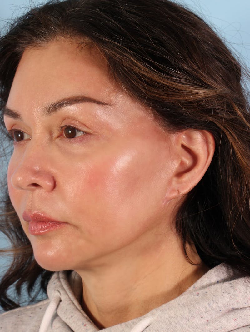 Facelift Surgery Before & After Gallery - Patient 980569 - Image 2