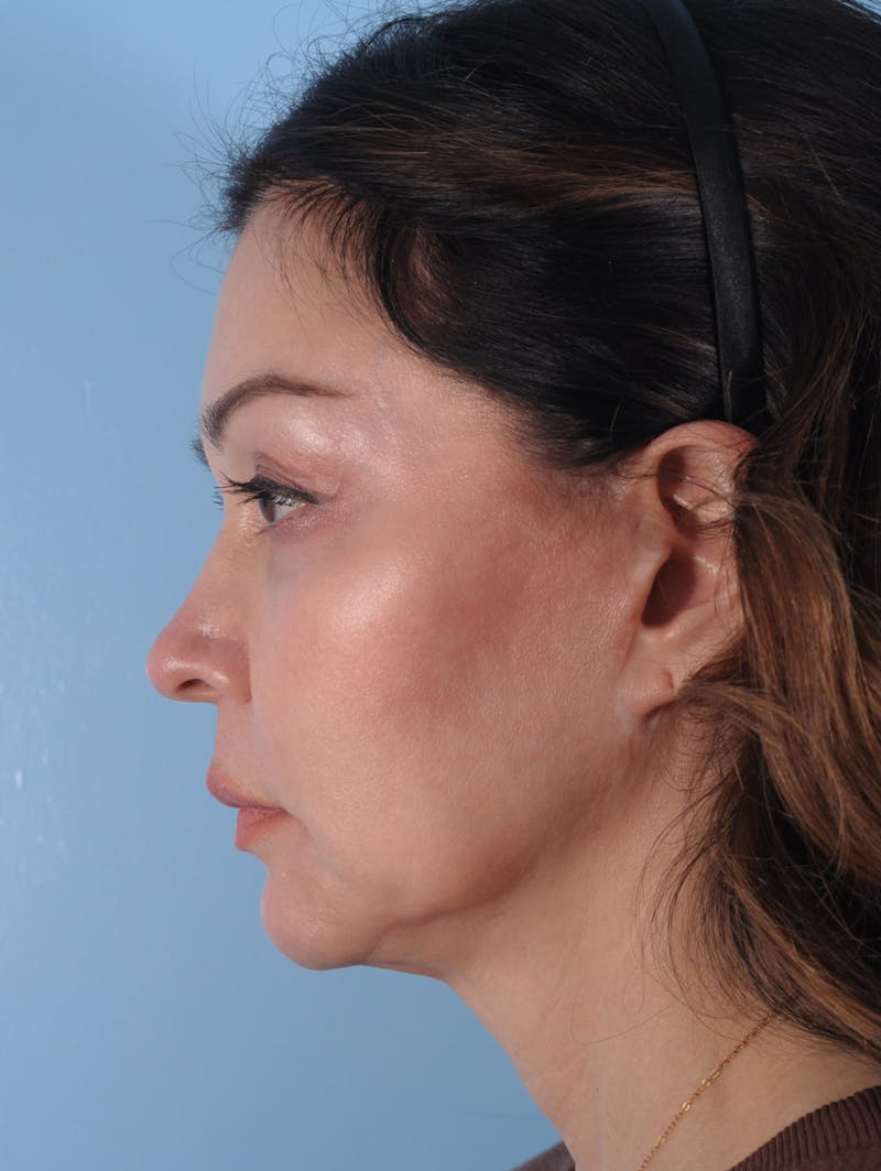 Facelift Surgery Before & After Gallery - Patient 980569 - Image 3