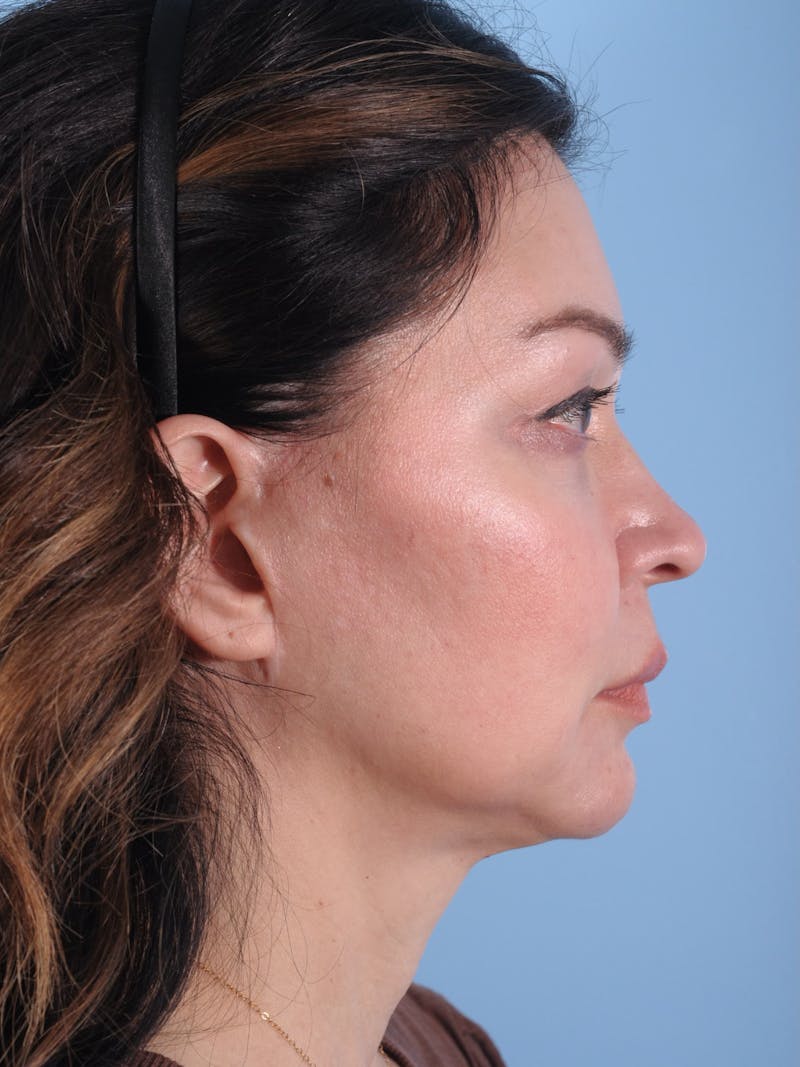 Facelift Surgery Before & After Gallery - Patient 980569 - Image 5